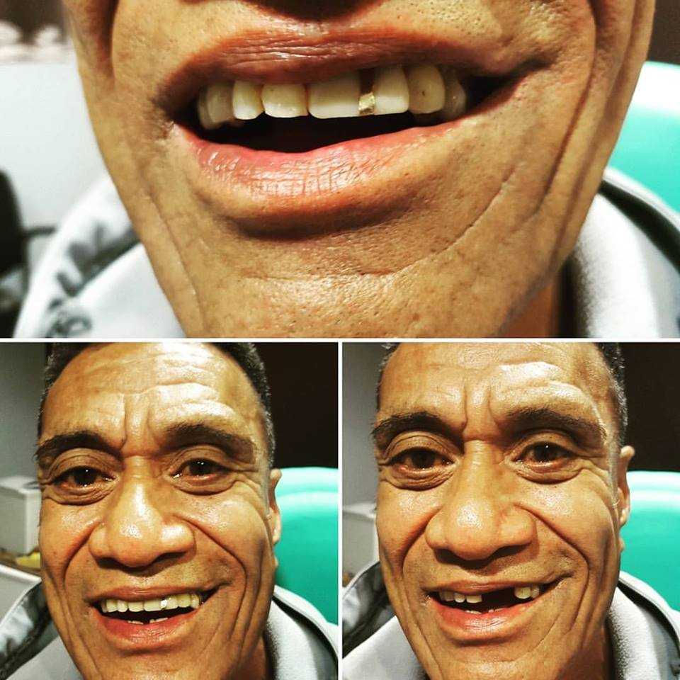 +get +false +teeth, +cost of +dentures, +denture +repair +auckland, +dentures +auckland, Allergy free Denture, Thermosens, Unbreakable Denture, Flexible Denture, Auckland Dentures, New Dentures, New Smile, Get Dentures, Papatoetoe Dentures, Manukau Dentures, South Auckland Dentures, Denture Repairs, Fix Broken Dentures, Denture Reline, Dentist, Fix Teeth, Fix Denture, Best Denture, Dentures Auckland, Dentures, Denture teeth, Partial Denture, new front tooth, new front teeth, Dental Crowns, Dental polish, Dental Clean, Dentist Clean, Dental Implants, Comfortable Denture, Guarantee Denture, Warranty Denture, Otara Denture, Denture, Smile Dental, Hillpark Dental, Papatoetoe Dentist, Denture Repairs, Denture Relines, Best Dentures, Quality Dentures, Designer Dentures, New Smile, WINZ Denture, Pension Dentures, Insurance Dentures, AMI Dentures, State Insurance Dentures, IAG Dentures, Affordable Dentures, Low Cost Dentures, Cheap Dentures, Otahuhu Dentures, South Auckland Dentures, Dentures Auckland,