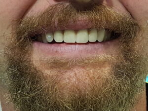 HIghly cosmetic denture ar the review appointment 3 years later for relininig to fix the fit.