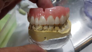 Denture that has just been completely rebased to look like new and is matching the lower model perfectly for a better bite.