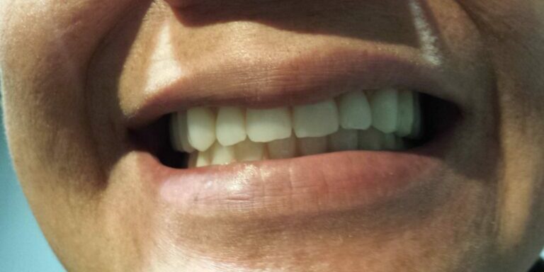 +get +false +teeth, +cost of +dentures, +denture +repair +auckland, +dentures +auckland, Allergy free Denture, Thermosens, Unbreakable Denture, Flexible Denture, Auckland Dentures, New Dentures, New Smile, Get Dentures, Papatoetoe Dentures, Manukau Dentures, South Auckland Dentures, Denture Repairs, Fix Broken Dentures, Denture Reline, Dentist, Fix Teeth, Fix Denture, Best Denture, Dentures Auckland, Dentures, Denture teeth, Partial Denture, new front tooth, new front teeth, Dental Crowns, Dental polish, Dental Clean, Dentist Clean, Dental Implants, Comfortable Denture, Guarantee Denture, Warranty Denture, Otara Denture, Denture, Smile Dental, Hillpark Dental, Papatoetoe Dentist, Denture Repairs, Denture Relines, Best Dentures, Quality Dentures, Designer Dentures, New Smile, WINZ Denture, Pension Dentures, Insurance Dentures, AMI Dentures, State Insurance Dentures, IAG Dentures, Affordable Dentures, Low Cost Dentures, Cheap Dentures, Otahuhu Dentures, South Auckland Dentures, Dentures Auckland,